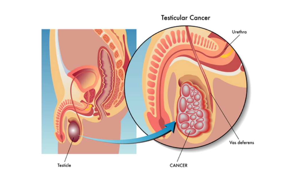 tratamiento cancer de testiculo